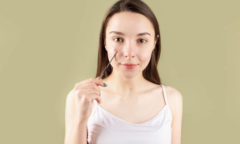 acne treatment techniques and tips
